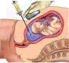 Prenatal Tanı